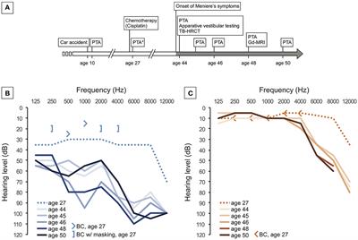 Clinical Imaging Findings of Vestibular Aqueduct Trauma in a Patient With Posttraumatic Meniere's Syndrome